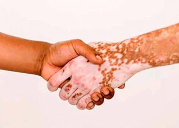 Exponerse al sol puede causar cáncer en personas con vitiIigo