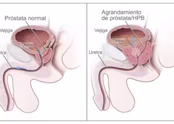 Combaten con hormonas la hiperplasia prostática benigna en hombre