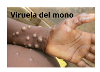 ¿Qué es la viruela del mono y cuáles son sus síntomas?