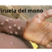 ¿Qué es la viruela del mono y cuáles son sus síntomas?