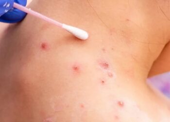 Capacitación y prevención ante la viruela símica. AMEXI / Foto: Secretaría de Salud.