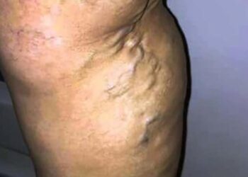 Várices. Incidencia al alza. AMEXI / Foto: Secretaría de Salud.