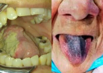 Cáncer de lengua, causa de la muerte de Fujimori