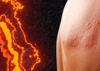 20 oct.- El Estado mexicano no tiene medicina preventiva para el Herpes Zóster, pese a su gran incidencia en la población adulta. /AMEXI. /FOTO: GSK.