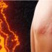 20 oct.- El Estado mexicano no tiene medicina preventiva para el Herpes Zóster, pese a su gran incidencia en la población adulta. /AMEXI. /FOTO: GSK.