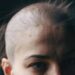 Alopecia en mujeres ¿Por qué ocurre y cuál es la más común?