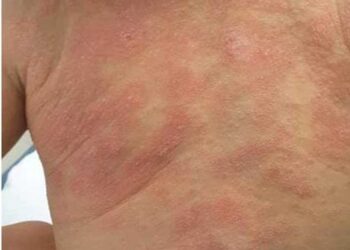Dermatitis atópica. Enfermedad en alza en México.