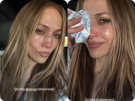 Jennifer Lopez muestra el resultado de su accidente en el rostro | AMEXI/FOTO: IG @jlo