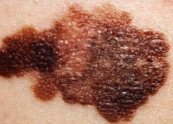 Aumentan en México los casos de cáncer de piel.