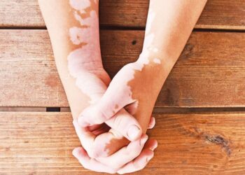 Día Mundial del Vitíligo