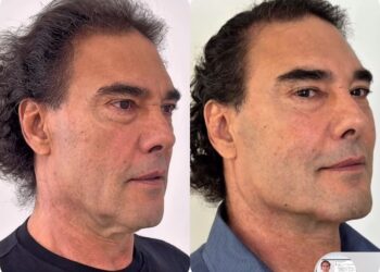 Eduardo Yáñez se hace procedimiento estético para rejuvenecer su rostro | AMEXI/FOTO: IG @eduardoyañezofc