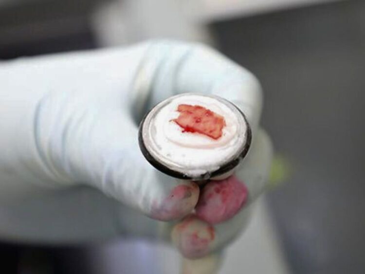 Cáncer tipo sarcoma. Riesgos y tratamientos. AMEXI