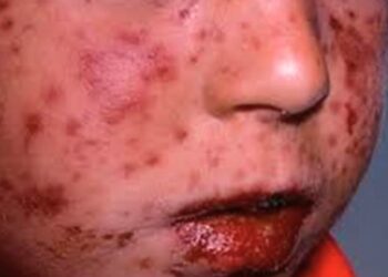 Alerta sanitaria en Oaxaca por aumento en casos de Coxsackie. AMEXI