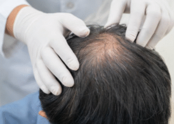 No es una enfermedad grave, pero la calvicie impacta en muchos aspectos de la vida