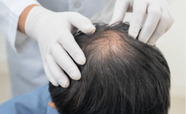 No es una enfermedad grave, pero la calvicie impacta en muchos aspectos de la vida