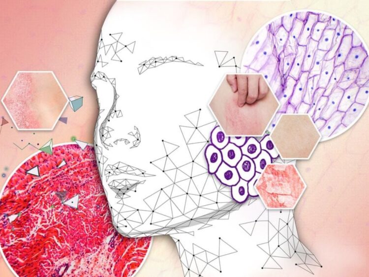 Psoriasis en México