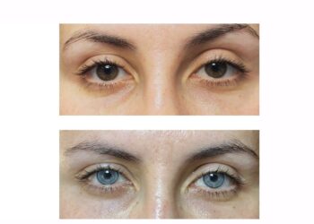 La queratopigmentación es el procedimiento quirúrgico al que recurrió Ninel Conde para cambiar el color de sus ojos a verde olivo. | AMEXI/FOTO: keratoclinic.com