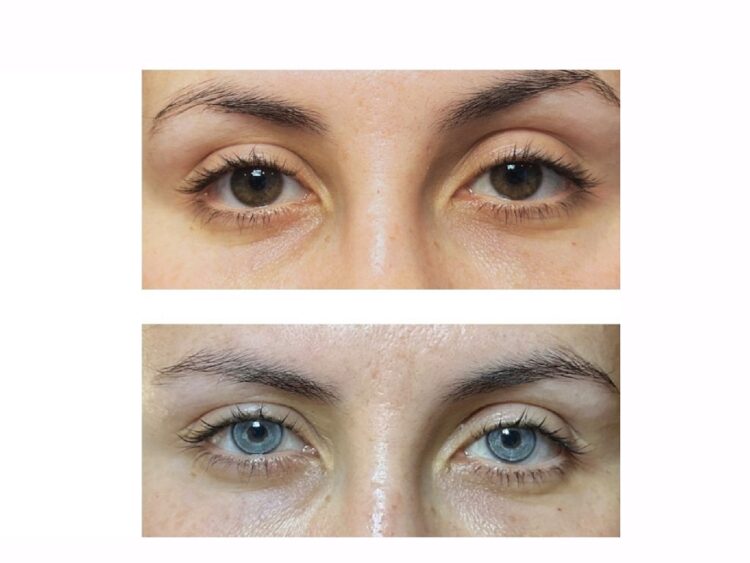 La queratopigmentación es el procedimiento quirúrgico al que recurrió Ninel Conde para cambiar el color de sus ojos a verde olivo. | AMEXI/FOTO: keratoclinic.com