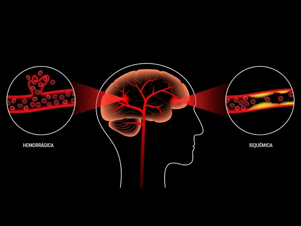 Tipos de ictus. AMEXI