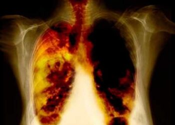 Cáncer de pulmón principal causa de muerte oncológica en hombres.