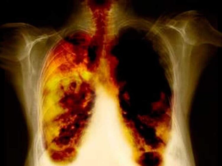 Cáncer de pulmón principal causa de muerte oncológica en hombres.