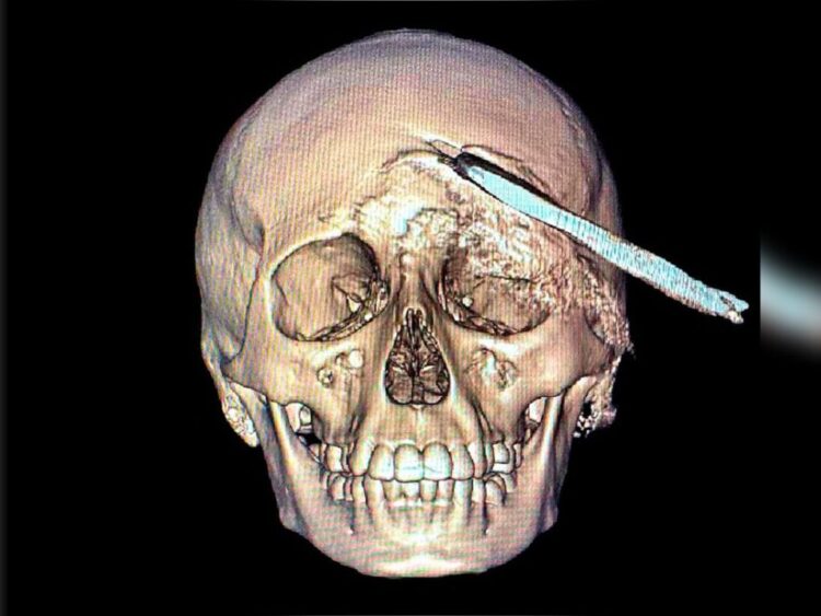 Hazaña médica: extraen del cráneo de un muchacho coa de 30 cm. /AMEXI