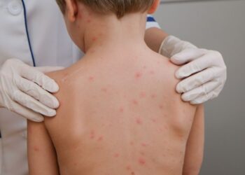 Brote de sarampión alcanza a los 32 estados del país