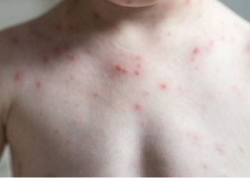 Sarampión en México: aumentan rapidez en contagios y el número de casos