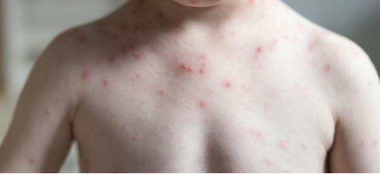 Sarampión en México: aumentan rapidez en contagios y el número de casos