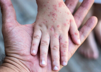 Brote de sarampión en México: 24 defunciones y más de 7,400 contagios confirmados