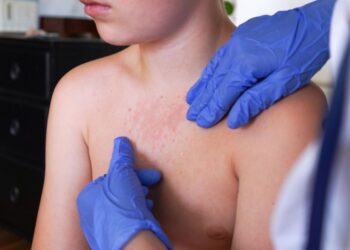 Urgen autoridades de EU a reforzar vacunación contra sarampión