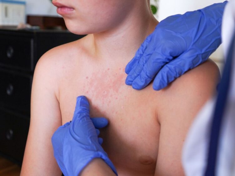 Urgen autoridades de EU a reforzar vacunación contra sarampión