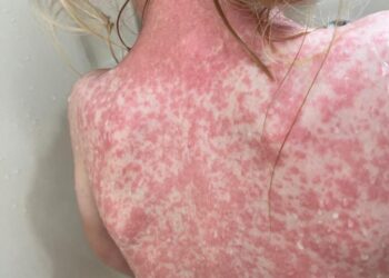 Cierran escuelas y obligan cubrebocas por sarampión en Jalisco