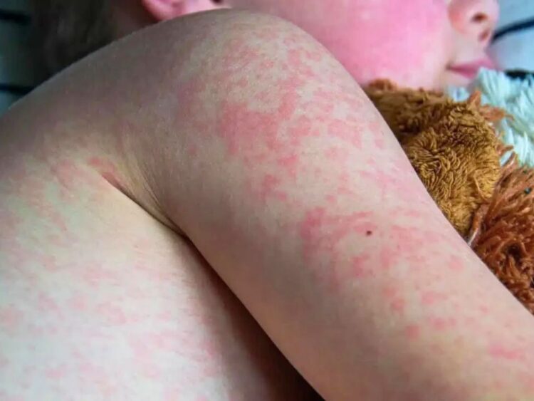 Primera muerte por sarampión en Chiapas 90% de casos sin vacuna.