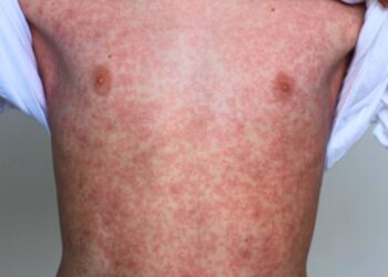 Refuerzan campañas de vacunación ante el aumento de contagios de sarampión. AMEXI Foto RRSS