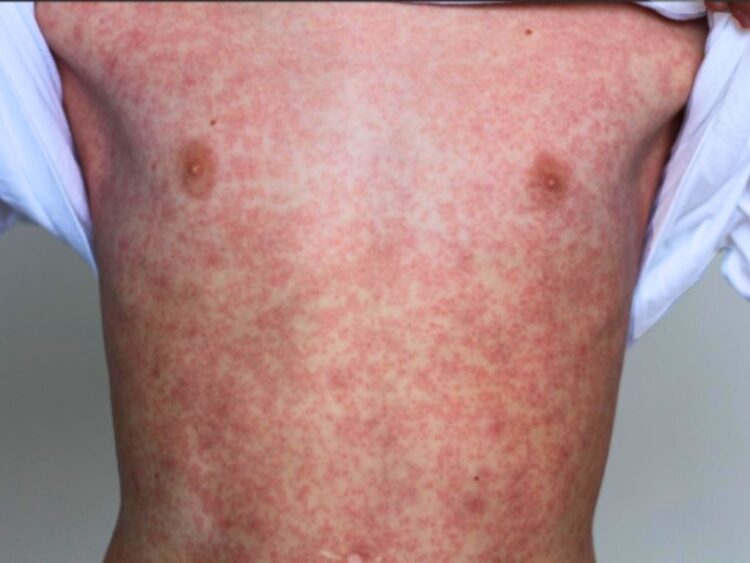 Refuerzan campañas de vacunación ante el aumento de contagios de sarampión. AMEXI Foto RRSS