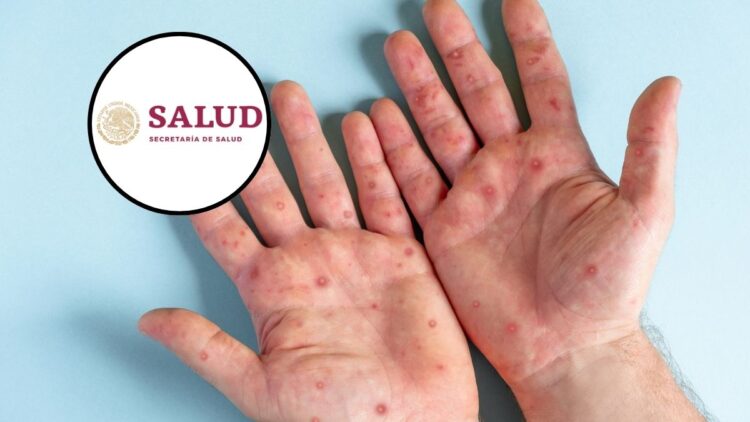 Autoridades de Salud mantienen llamado a vacunarse contra el sarampión