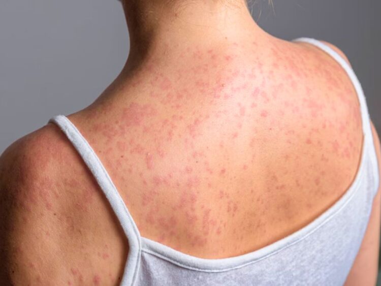 Brote activo de sarampión en México