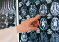 Infarto cerebral causas de discapacidad y mortalidad en México