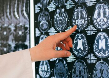 Infarto cerebral causas de discapacidad y mortalidad en México