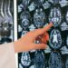 Infarto cerebral causas de discapacidad y mortalidad en México