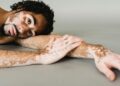 Día Mundial del Vitiligo. AMEXI Foto Canva