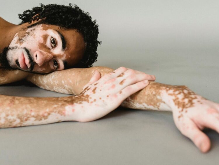 Día Mundial del Vitiligo. AMEXI Foto Canva