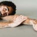 Día Mundial del Vitiligo. AMEXI Foto Canva