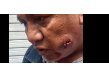 Profesor de la CNTE resulta herido  de bala en el rostro durante enfrentamiento en el Zócalo