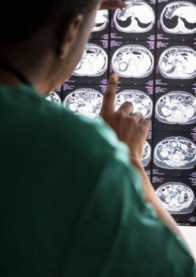 Hay varios factores de riesgo para la aparición de un ACV, ya que este evento vascular cerebral o cardíaco, se pueden provocar por varias situaciones.