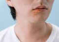 ¿Cada vez más mexicanos con sífilis ¿También los bebés?