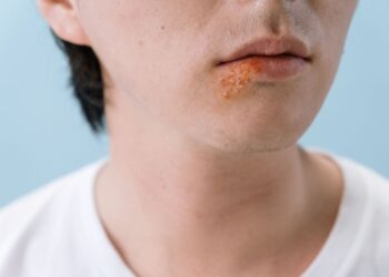 ¿Cada vez más mexicanos con sífilis ¿También los bebés?