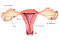 Endometriosis en México. AMEXI Foto Ilustración médica