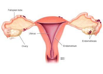 Endometriosis en México. AMEXI Foto Ilustración médica